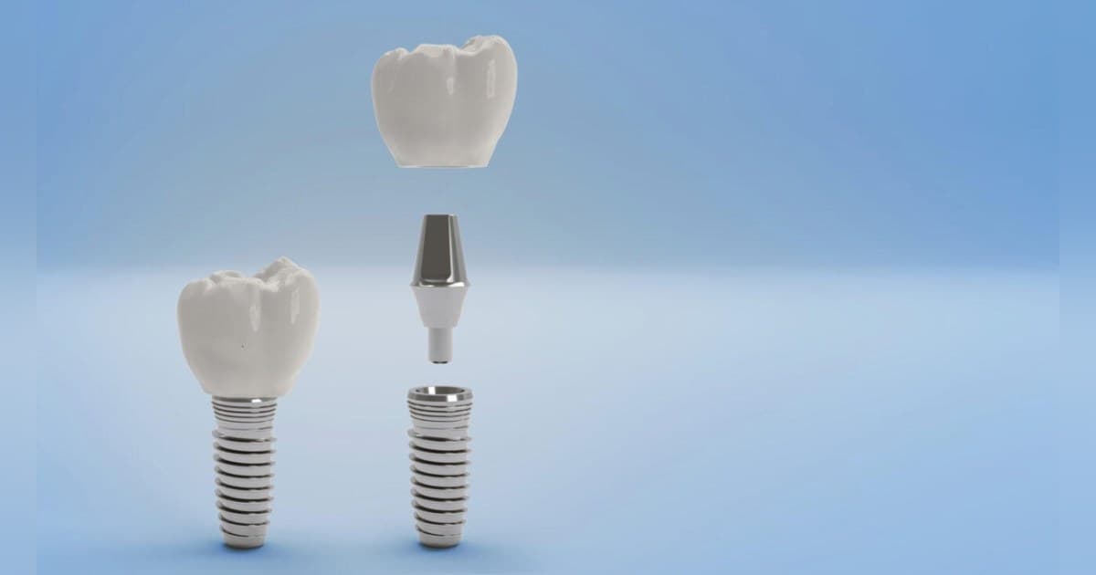 Le Centre Dentaire Gunbarrel publie des recommandations cliniques sur les options professionnelles de blanchiment des dents