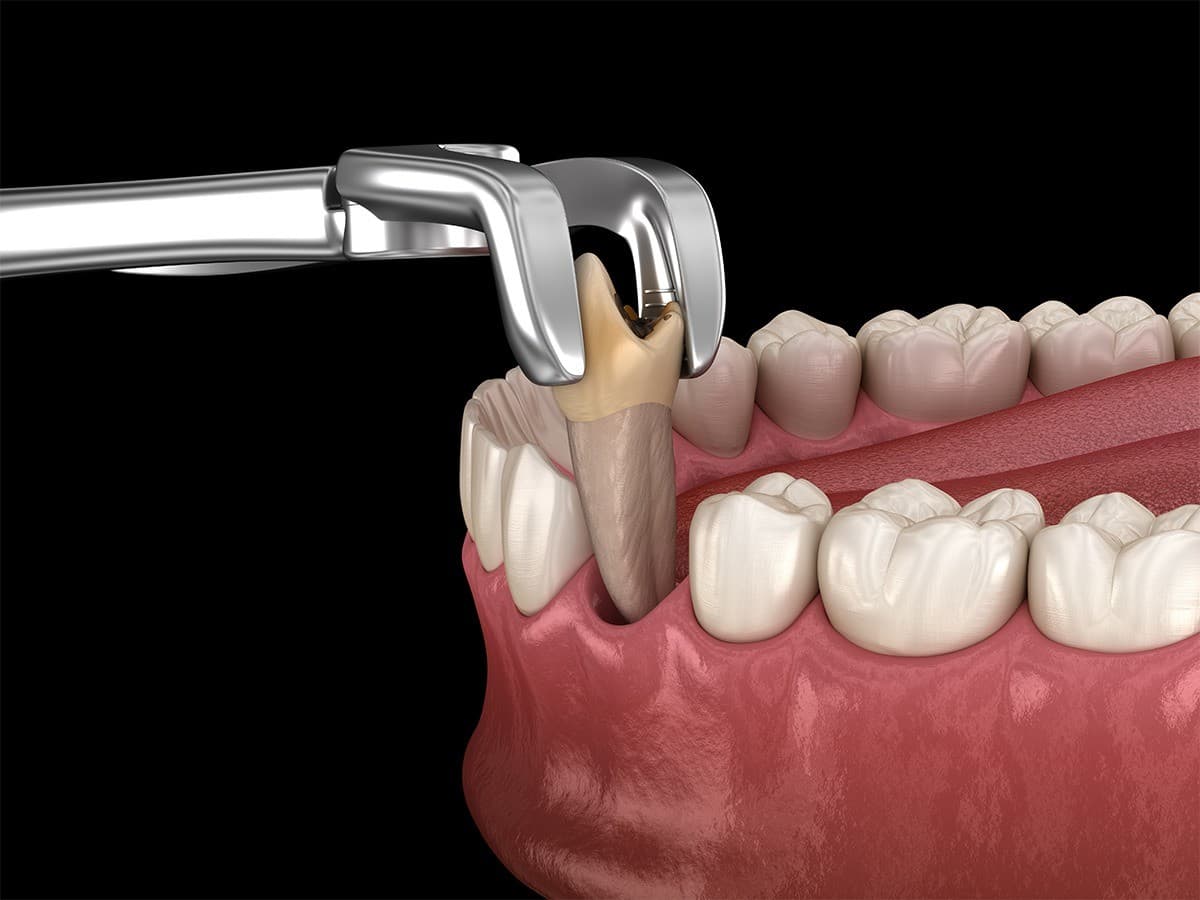 Un cabinet de chirurgie buccale de Sioux Falls publie un guide pour apaiser l'anxiété des patients concernant les extractions dentaires